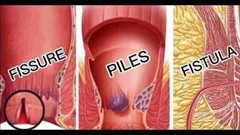 Himalaya Pilex Forte Tablets – 10 Boxes | Herbal Piles Support | Exp 01/2026