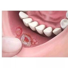Pack of 3 Candid Mouth Paint For Oral Thrush Treatment 25 ml