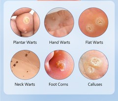 20G Reinreude Wart Remover Plantar Wart Removers for Corns Feet Body Fast Acting