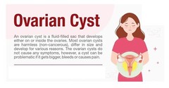 OVARIAN CYST FREE REMOVAL 4 ME – TO TREAT & PREVENT Made in USA – 120 capsules