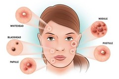 ACNE TEA with Neem – Addresses internal root causes of persistent skin breakouts