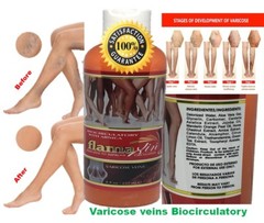 leg vein Support Herbal Ointment Varicose Veins Vasculitis support Foot Care Cre