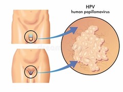 NATURAL HELP FOR HPV FREEPAPILLOMA MEN & WOMEN – MADE IN USA