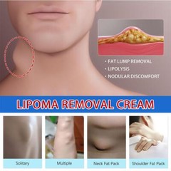 Discomfort Lipoma Soothing Cream Instant Ointment Relieving 20g Fat-Agglo Sell