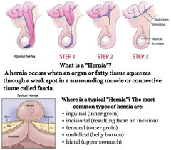 Ayuda con Hernia Umbilical, Hernia Discal, Hernia Vertebral, Hernia Inguinal