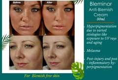 Himalaya BLEMINOR Antiblemish Cream Herbal Pack of 3 x 30ml Each FREE SHIP 2028