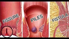 Himalaya Pilex Forte Tablets – 5 Boxes | Herbal Piles Support | Exp 07/2027