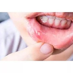 PACK OF 3 – CANDID MOUTH PAINT FOR ORAL THRUSH TREATMENT 25 ML EACH
