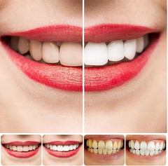 SP 4 Ultra Whitening Toothpaste for Teeth Cleaner & Advanced Stain Removal 50gm