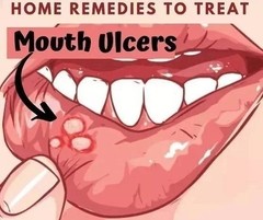 Pack of 3 Candid Mouth Paint For Oral Thrush Treatment 25 ml